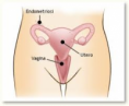 /album/galleria-fotografica/endometriosi-1-png/